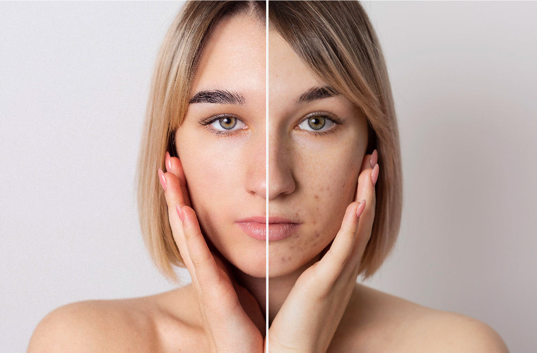 شنو هو الكلف و شنو اسبابه وشنو الحلول