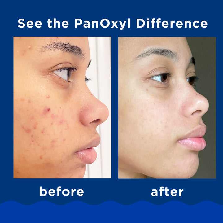 PanOxyl Acne Foaming Wash Benzoyl Peroxide 10% Max Strength - 156g |  بانوكسيل غسول رغوي لحب الشباب البنزويل بيروكسايد 10%  - 156 غرام