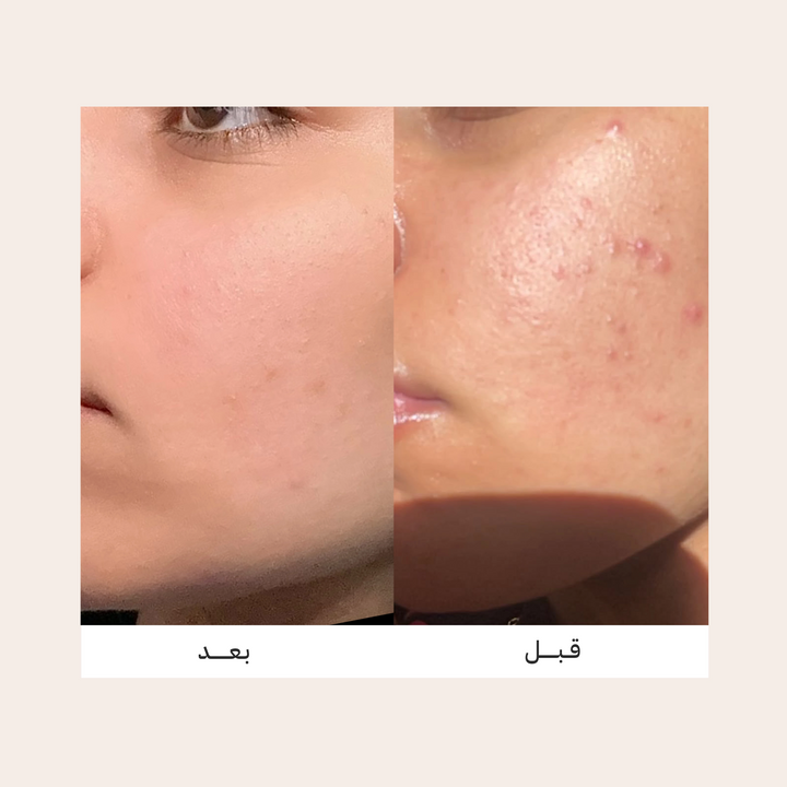 VIVIAN 10% Azelaic Acid Cream Multi-Care Formula - 40ml | فيفيان كريم حمض الأزيليك 10% - 40مل