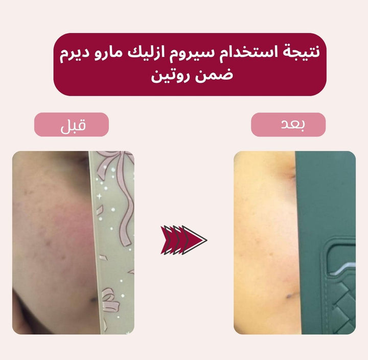 maru.derm Azelaic Acid Solution 10%serum - 30ml | مارو.ديرم سيروم الازليك اسيد 10% - 30 مل