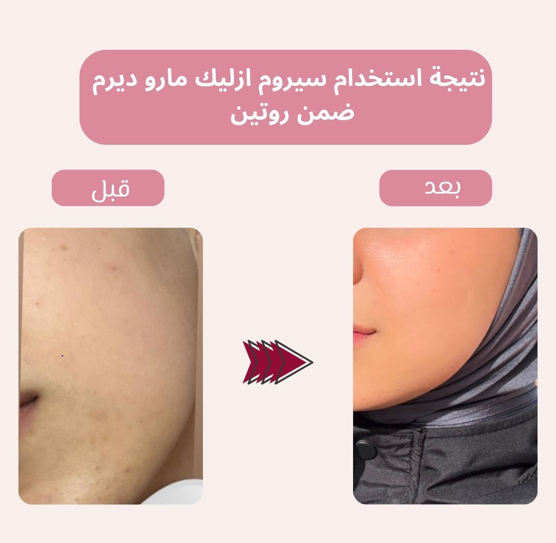 maru.derm Azelaic Acid Solution 10%serum - 30ml | مارو.ديرم سيروم الازليك اسيد 10% - 30 مل