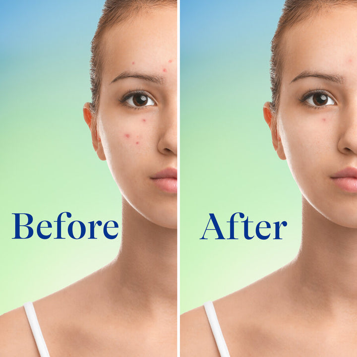 Differin 10% Benzoyl Peroxide Acne Foaming Cleanser - 148ml | ديفيرين غسول رغوي معالج لحب الشباب - 148 مل