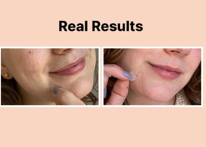 Cosrx Acne Pimple Master Patch - 24 Pimple Treatment Patch | كوزركس لصقات موضعية لعلاج الحبوب - 24 قطعة