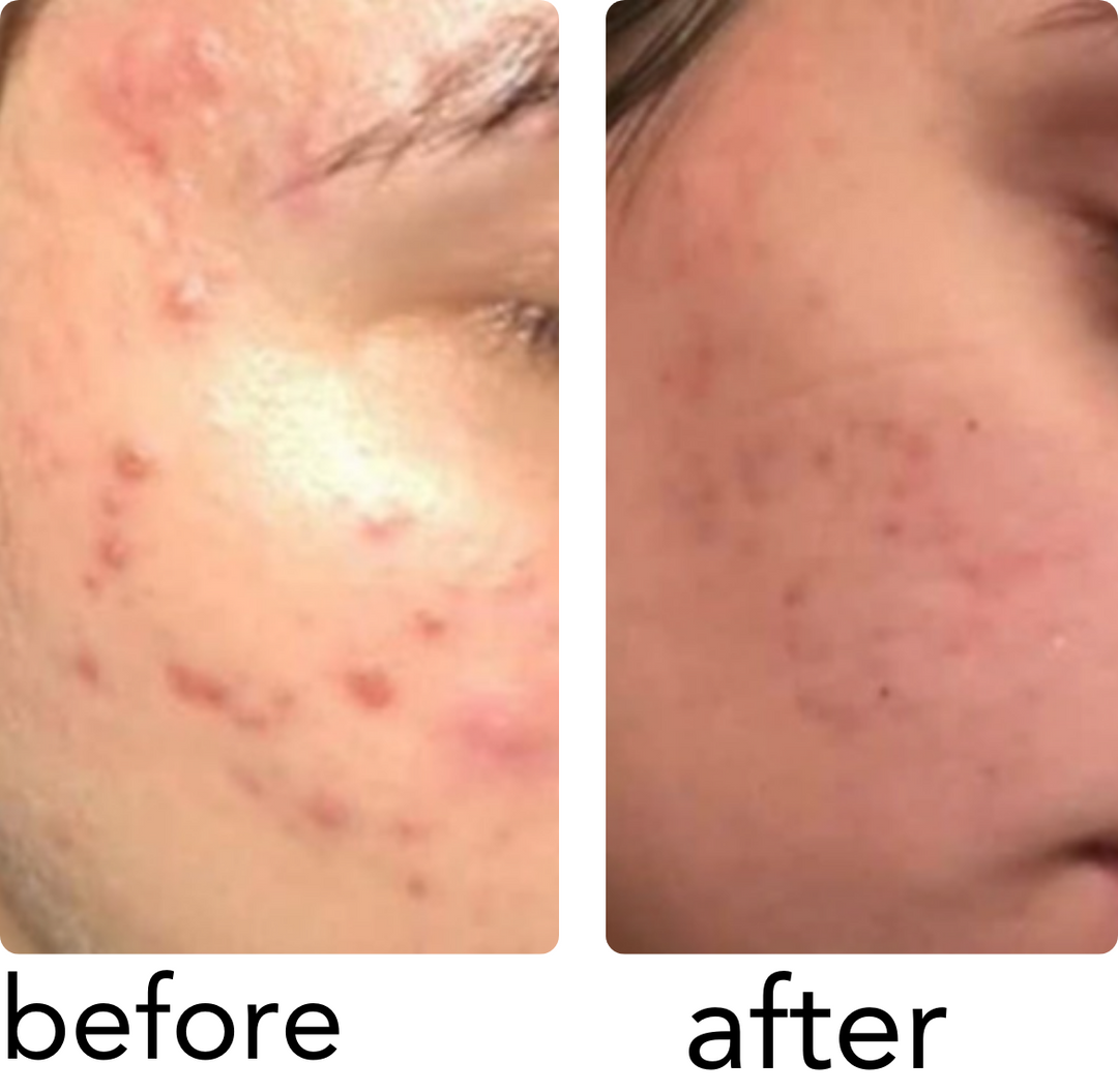 PanOxyl Acne Foaming Wash Benzoyl Peroxide 10% Max Strength - 156g |  بانوكسيل غسول رغوي لحب الشباب البنزويل بيروكسايد 10%  - 156 غرام