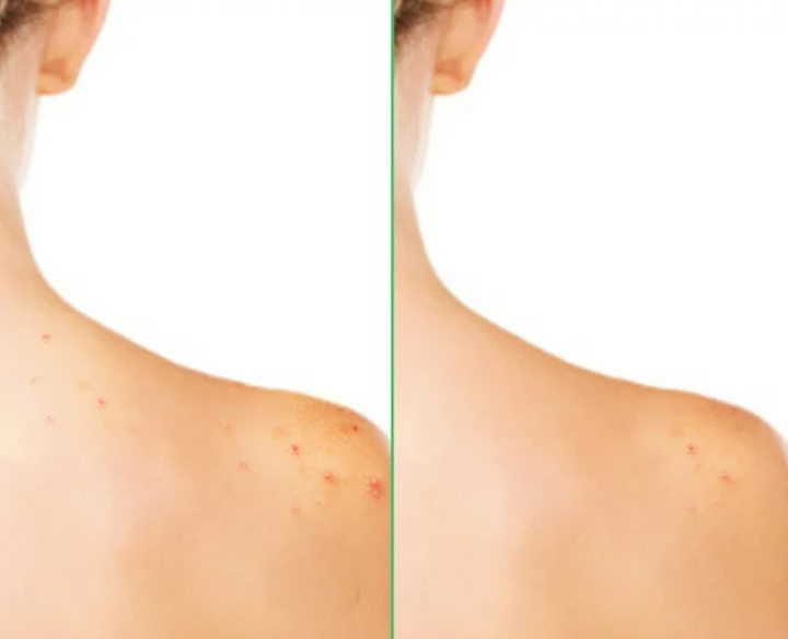 DIFFERIN Acne Clearing Body Wash - 295ml | ديفيرين غسول لعلاج حب الشباب - 295 مل