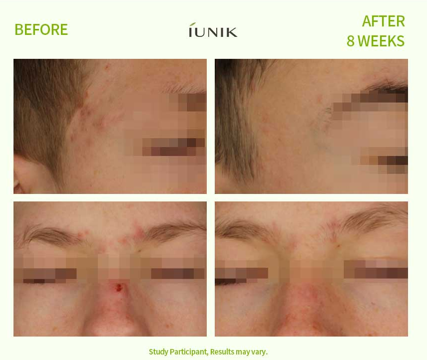 IUNIK Centella Calming Ac Spot Cream - 20ml | ايونيك كريم السينتيلا الموضعي المهدئ للبشرة - 20 مل