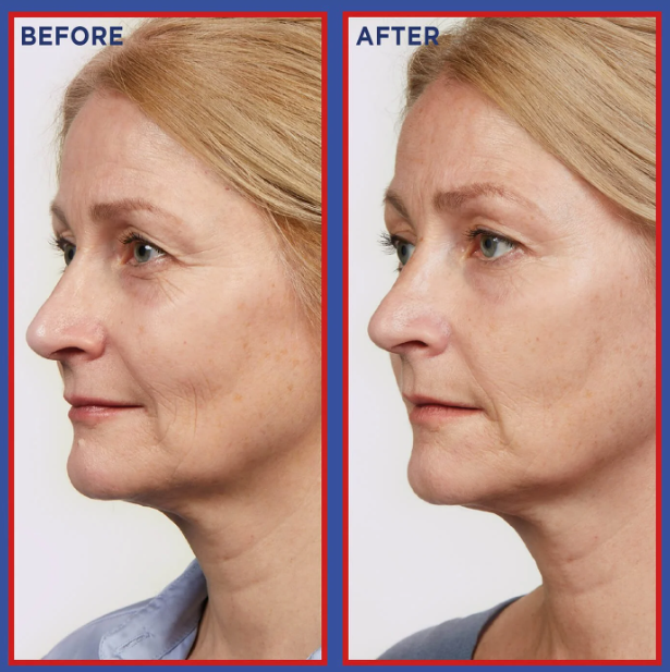 L’Oreal Revitalift Laser 0.2% Pure Retinol - 30ml | لوريال سيروم الريتينول 0.2% النقي - 30 مل