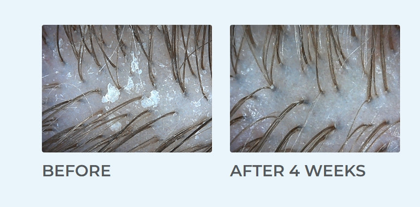 Dermedic Capilarte Trichologic Scalp Peel - 100ml |ديرميديك كابيلارت مقشّر فروة الرأس العلاجي – 100 مل