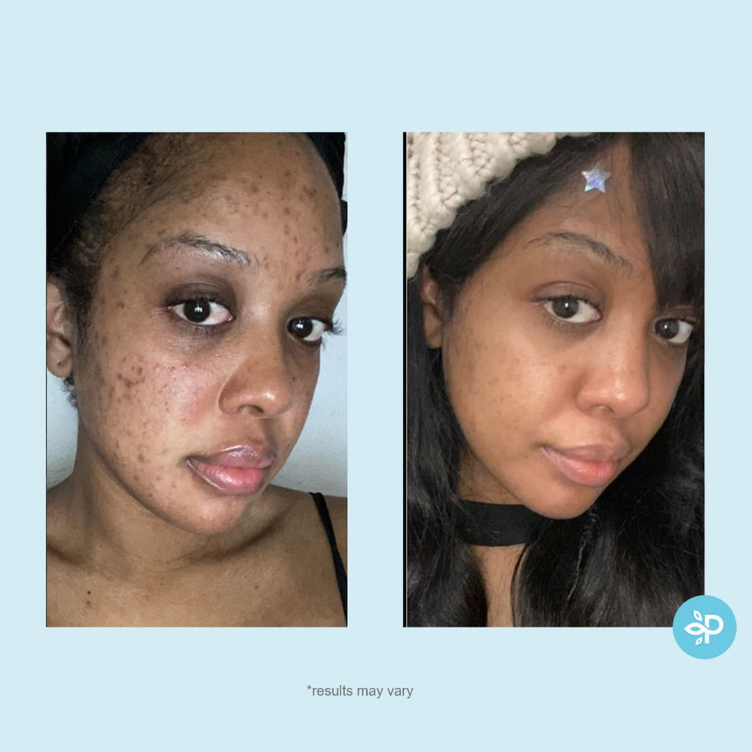 Perfect Image Salicylic 10% Gel Peel - 30ml | بيرفكت إيمج مقشر بحمض السالسيليك 10 % - 30 مل