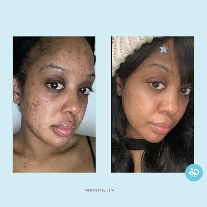 Perfect Image Salicylic 10% Gel Peel - 30ml | بيرفكت إيمج مقشر بحمض السالسيليك 10 % - 30 مل