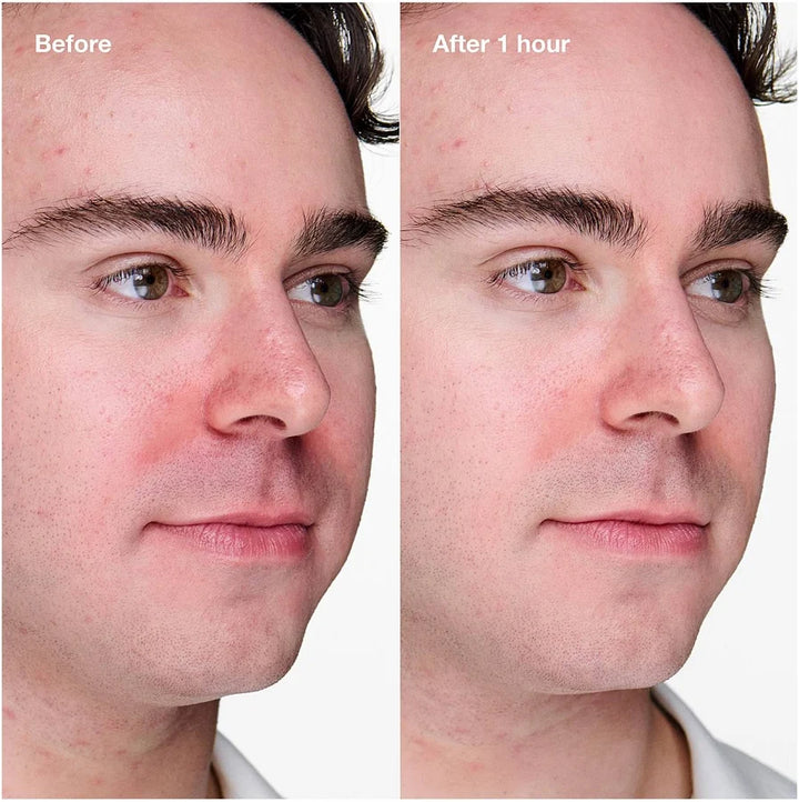 Clinique Anti-Blemish Solutions 3-Step Skin Care System Case 3 Pieces| كلينيك  مجموعة عناية ثلاثية للبشرة المعرّضة للحبوب - 3 قطع