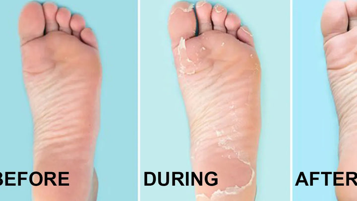 Baby Foot Peel - 2 x 35ml | بيبي فوت مقشر قدم - 2 × 35 مل