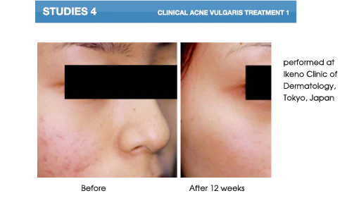 AcneVit Anti-Acne Serum - 30ml |اكني فيت  سيروم مضاد لحب الشباب - 30 مل