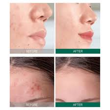 SOME BY MI Aha.Bha.Pha 30Days Starter Limited Edition 4 Pcs Set | سوم باي مي مجموعة الاحماض لتهدئة البشرة المعرضة للحبوب - 4 قطع